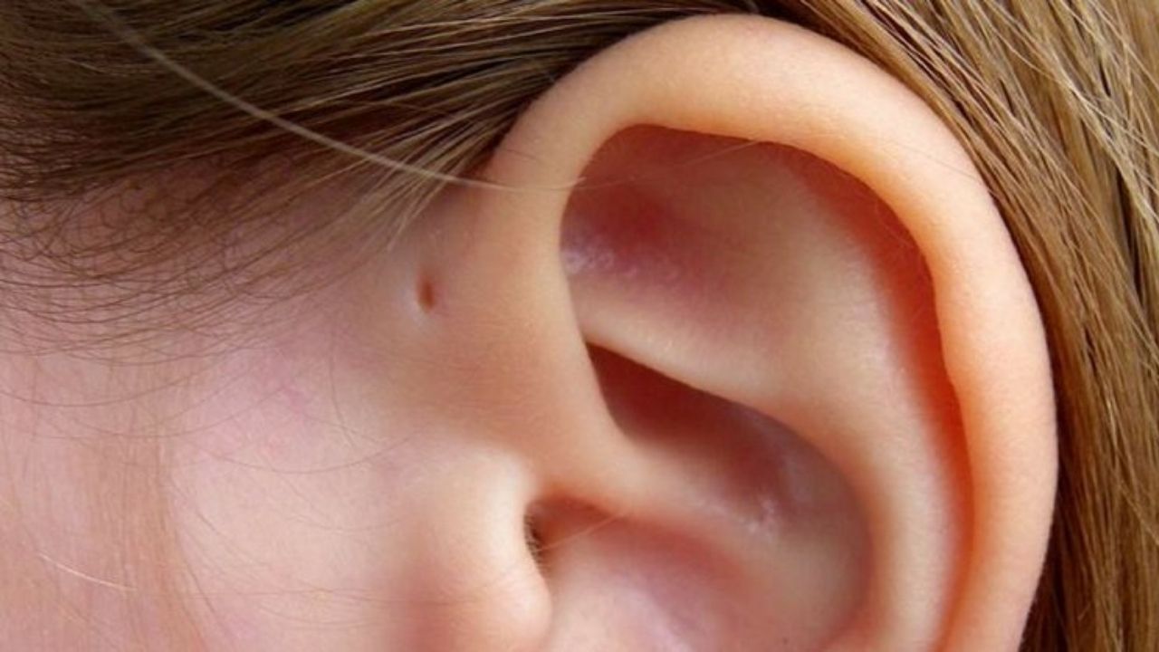 Sinus Preauricular yang ada di dekat telinga